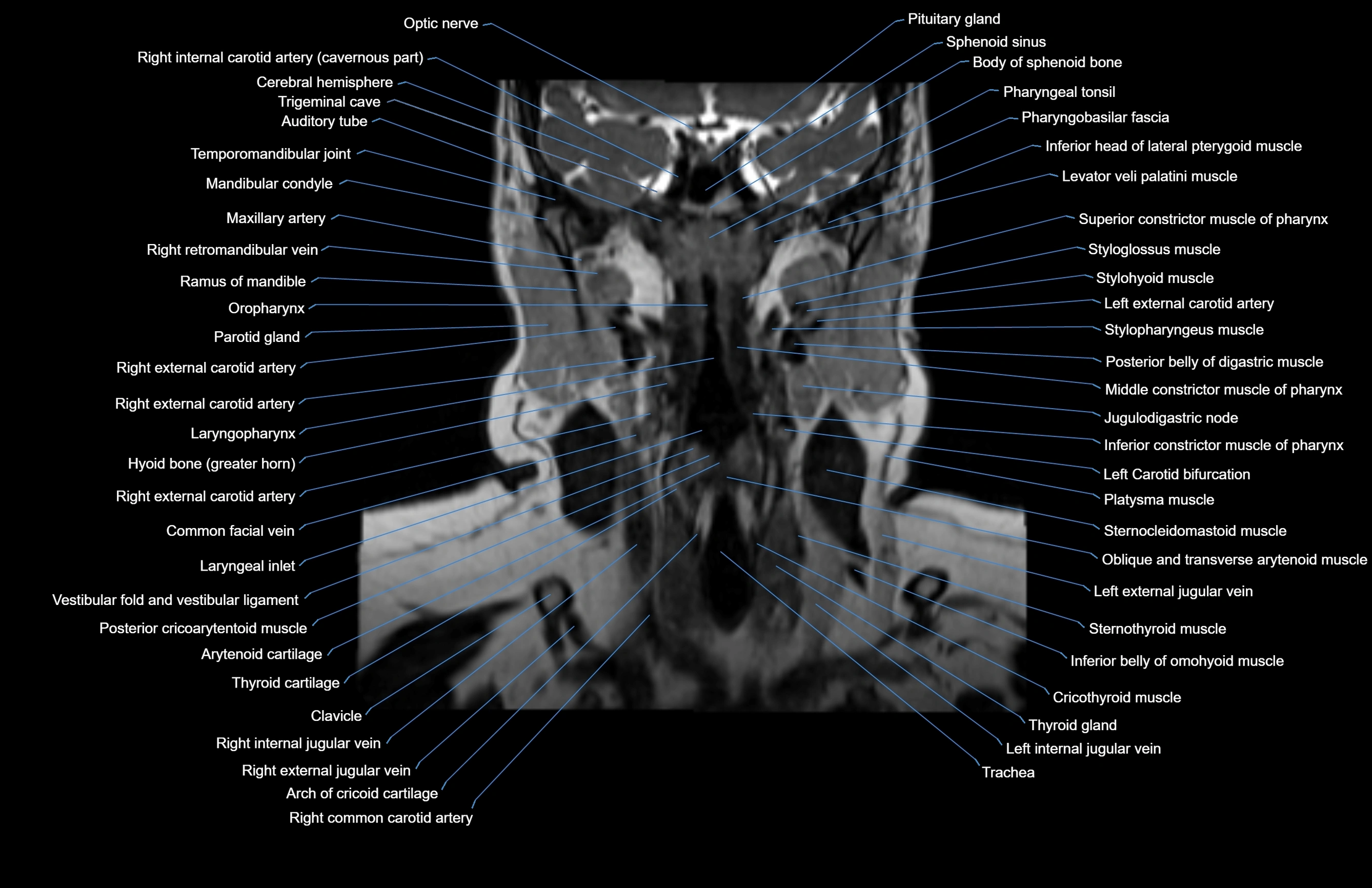 Neck coronal cross sectional MRI anatomy 3T MRI  image-img-00001-00040.webp